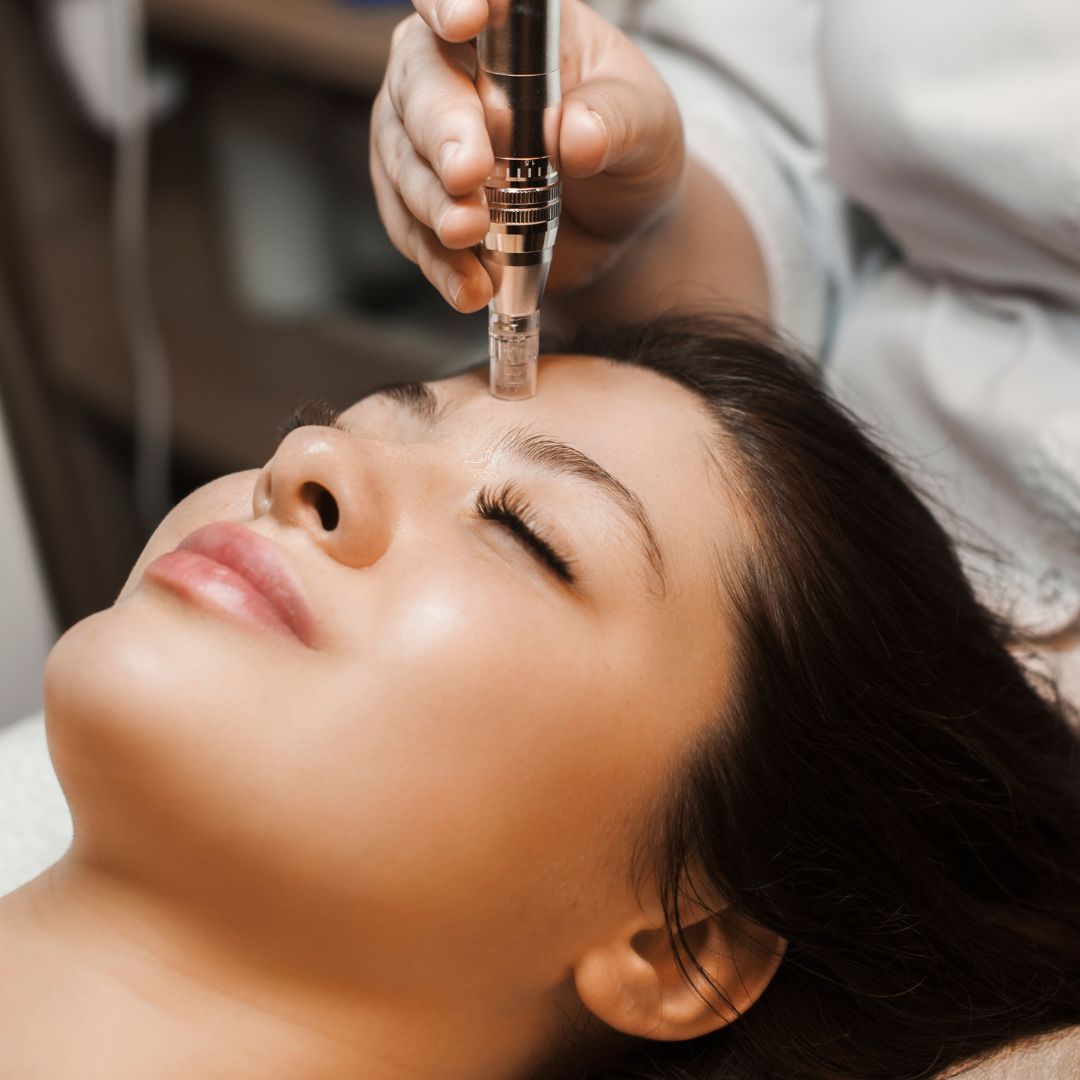 microneedling