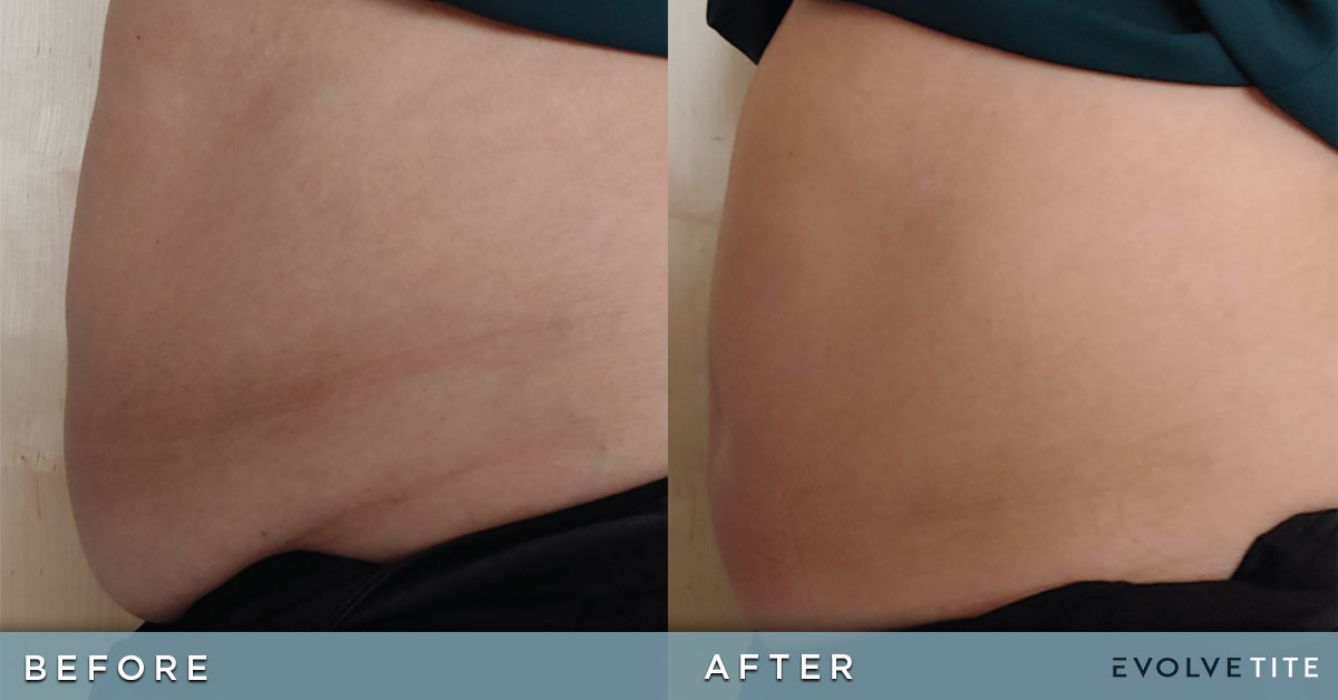 the before and after fat reduction