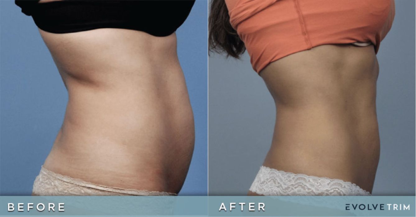 before and after muscle toning