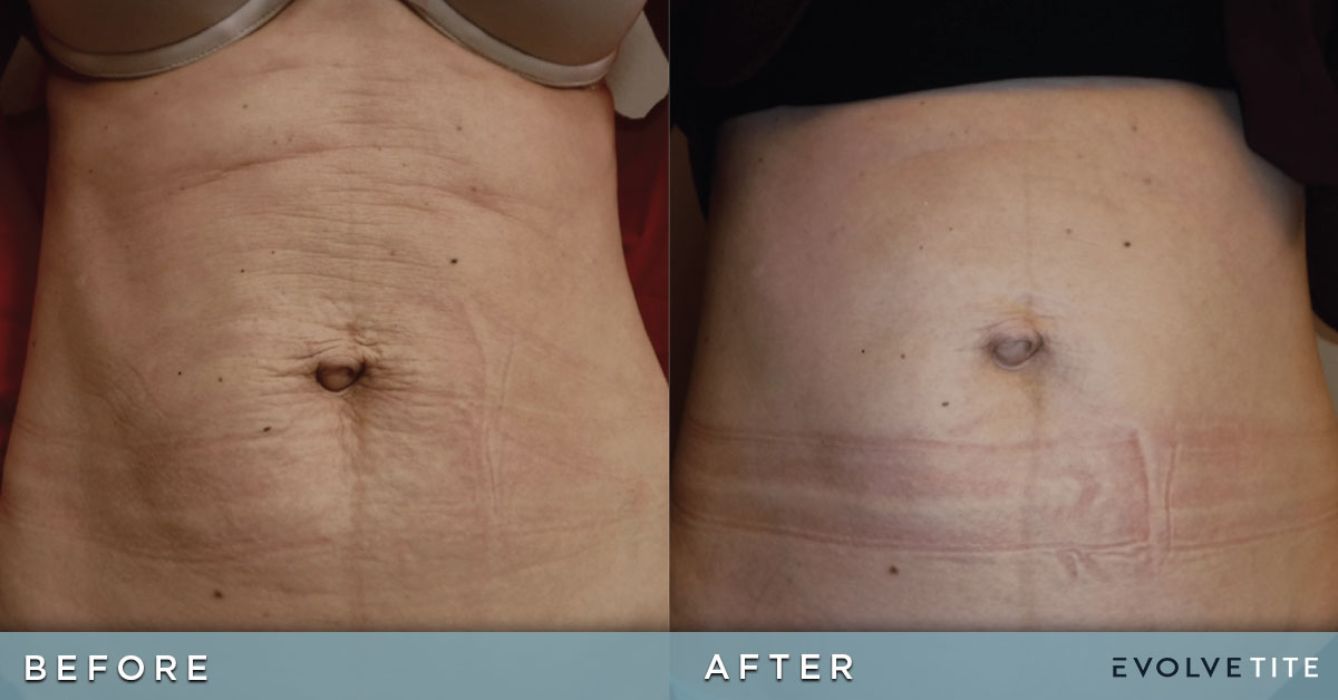 before and after skin tightenting