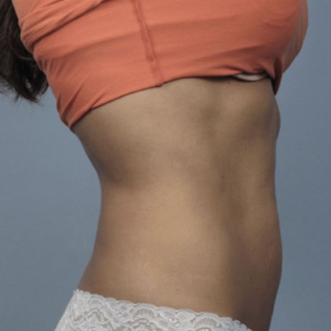 abdominal body sculpting results
