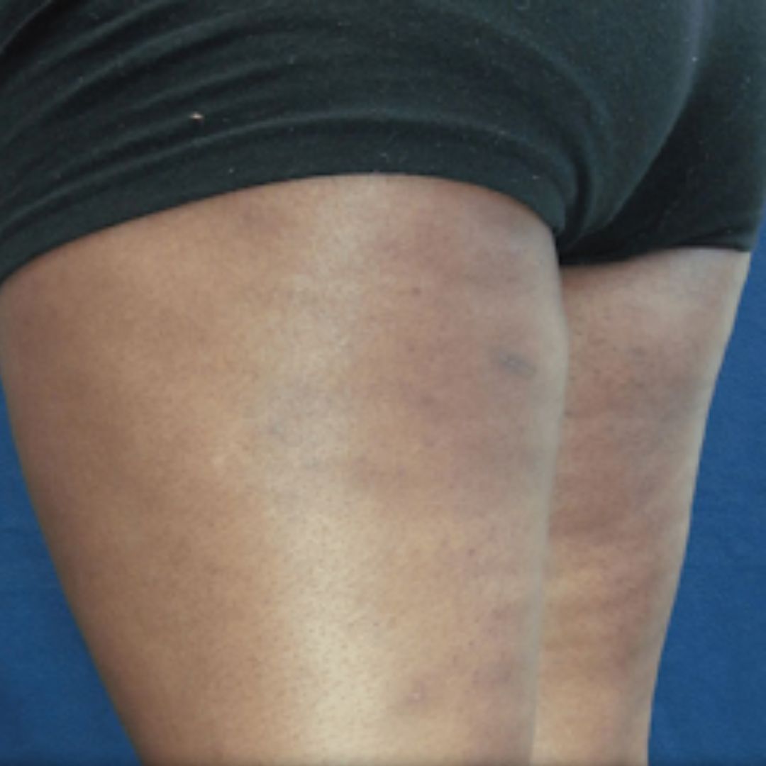 thigh body sculpting results