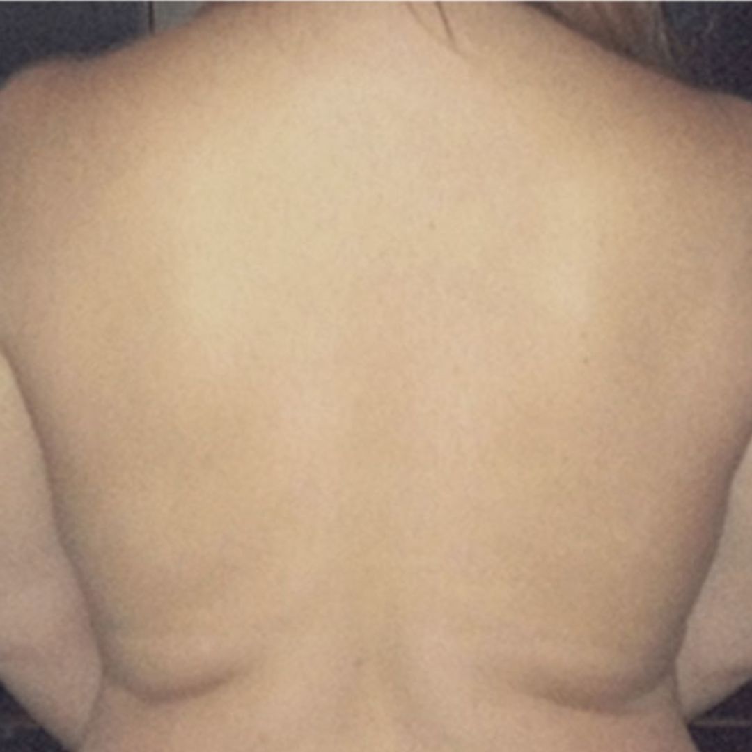 back and bra line contouring results