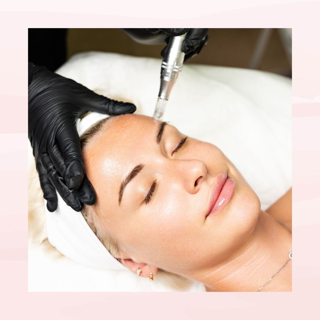 Microneedling 1