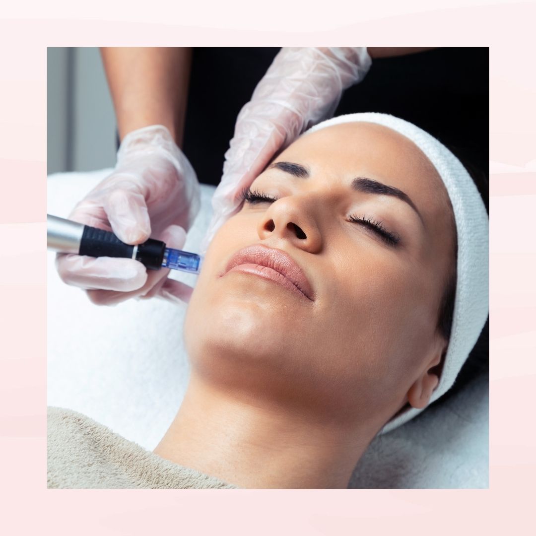 Microneedling 3